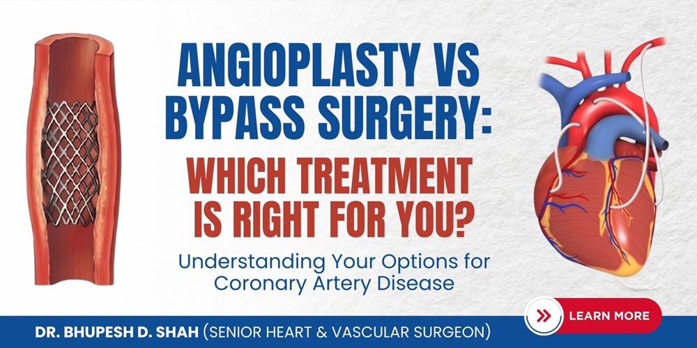 Angioplasty vs Bypass Surgery - Which Treatment Is Right for you